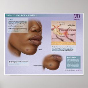 Póster Melalogic Popping Pimples Poster médico