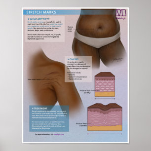 Póster Melalogic Stretch Marcas Poster médico