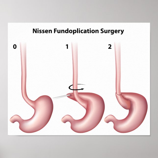 Póster Nissen Fundoplicación estomacal Poster Cirugía (Frente)