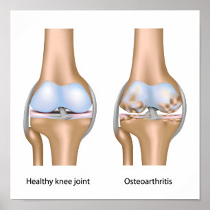 Póster Osteoartritis del poster de la junta de rodilla