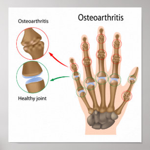 Póster Osteoartritis del poster de la mano