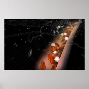 Póster Placa en las arterias