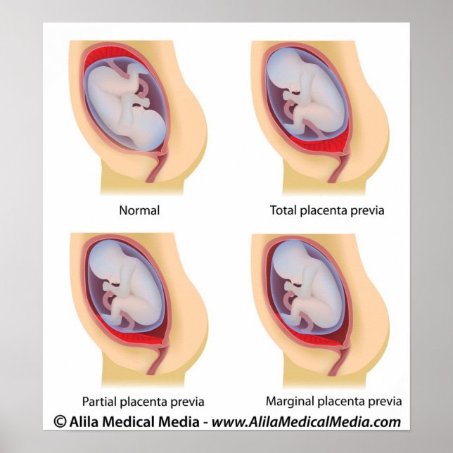 Póster Placenta previa poster (Frente)