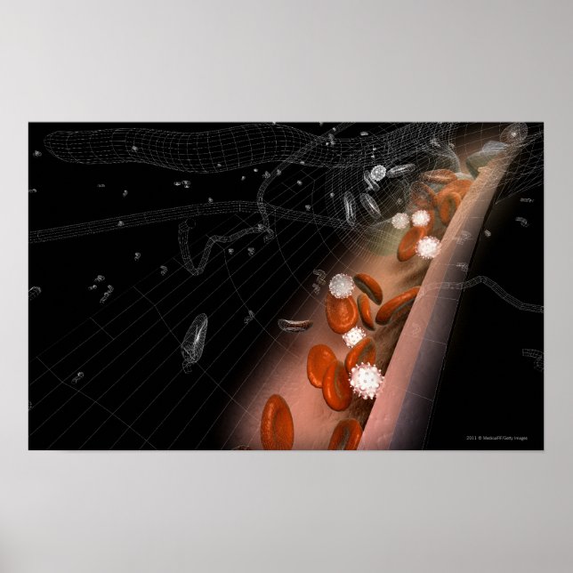 Póster Plaque en las arterias (Frente)