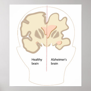 Póster Poster cerebral de la enfermedad de Alzheimer