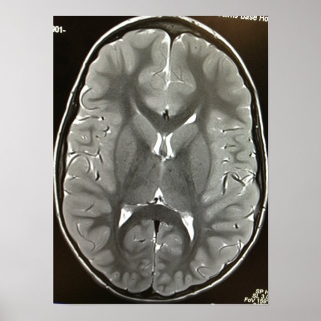 Póster Poster cerebral de MRI (Frente)