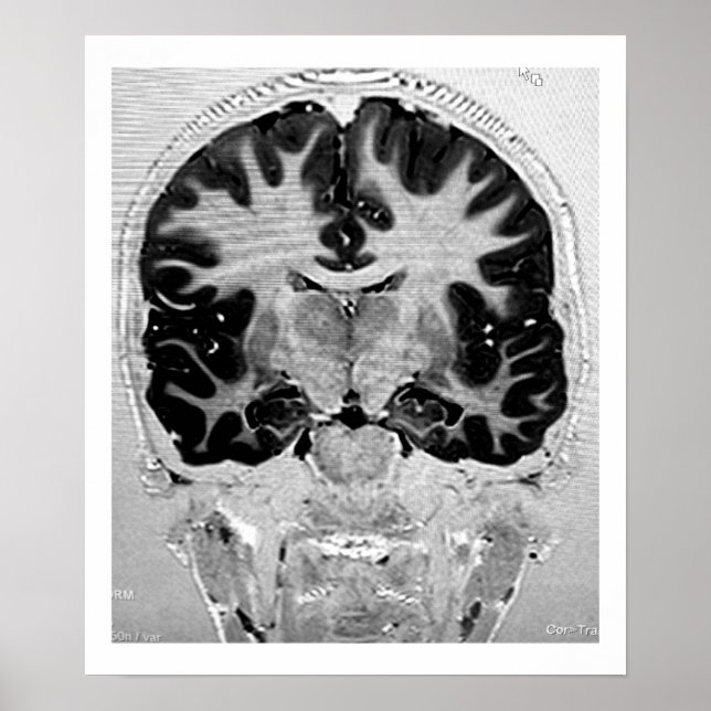 Póster Poster de cabeza de MRI (Frente)