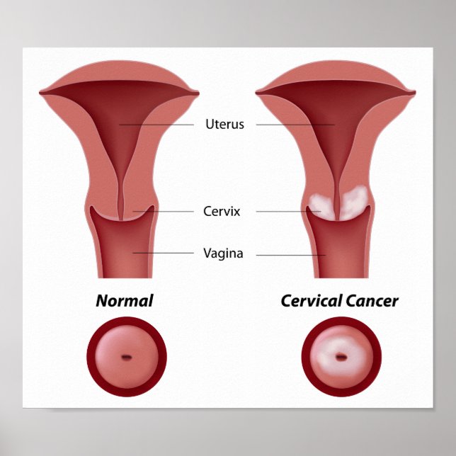 Póster Poster de cáncer cervical (Frente)