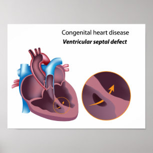 Póster Poster de cardiopatía congénita