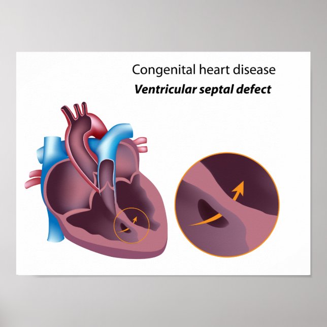 Póster Poster de cardiopatía congénita (Frente)