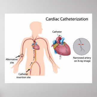 Póster Poster de cateterización cardiaca