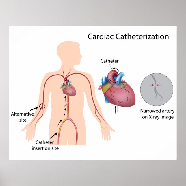 Póster Poster de cateterización cardiaca (Frente)
