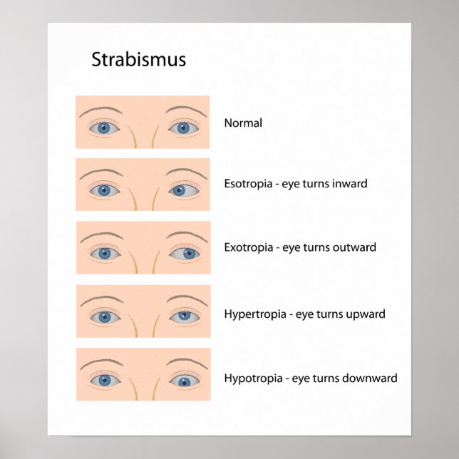 Póster Poster de defectos oculares de Strabismus (Frente)