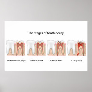 Póster Poster de descomposición dental