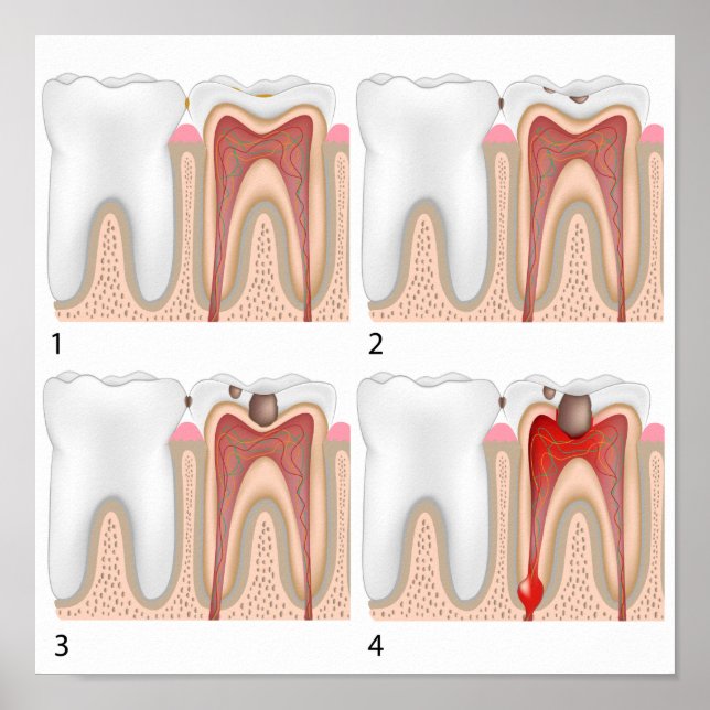 Póster Poster de descomposición dental (Frente)