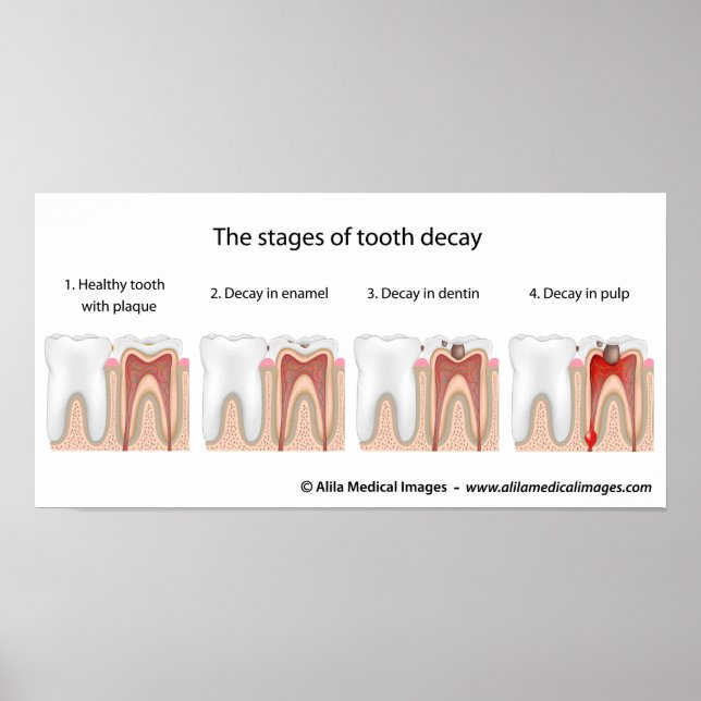 Póster Poster de descomposición dental (Frente)
