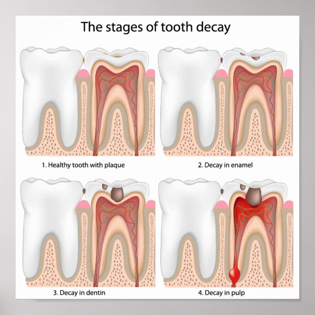 Póster Poster de descomposición dental (Frente)