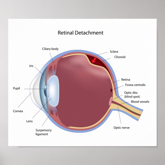 Póster Poster de desprendimiento de retina ocular (Frente)