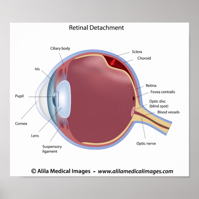 Póster Poster de desprendimiento de retina ocular (Frente)