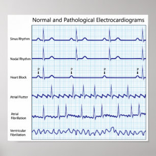 Póster Poster de ecg normal y patológico