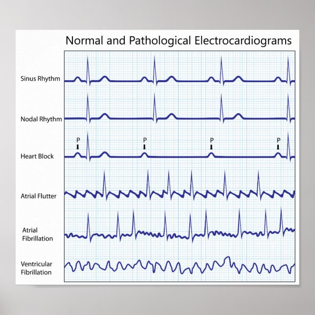 Póster Poster de ecg normal y patológico (Frente)