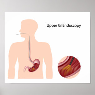 Póster Poster de endoscopia GI superior