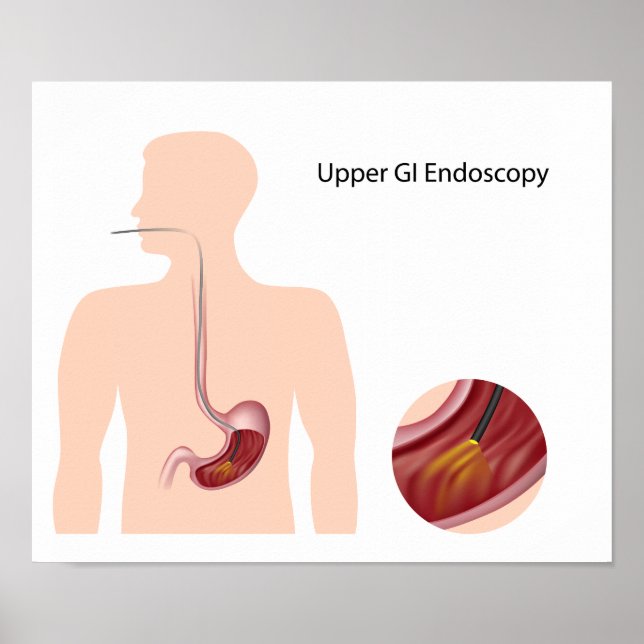 Póster Poster de endoscopia GI superior (Frente)