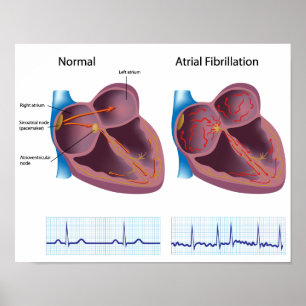 Póster Poster de fibrilación auricular