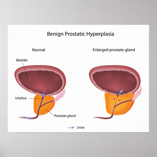 Póster Poster de hiperplasia prostática benigna (Frente)