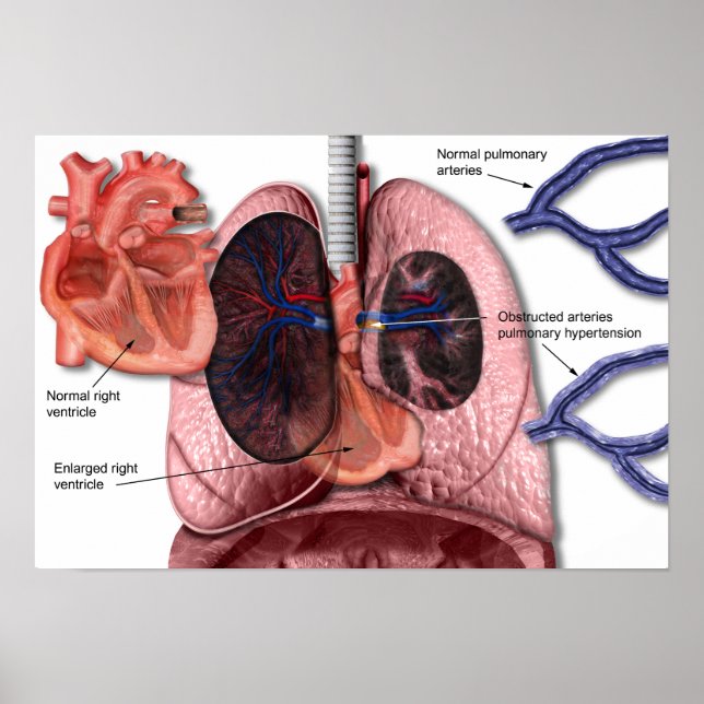 Póster Poster de hipertensión pulmonar (Frente)