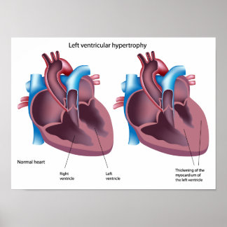 Póster Poster de hipertrofia cardiaca