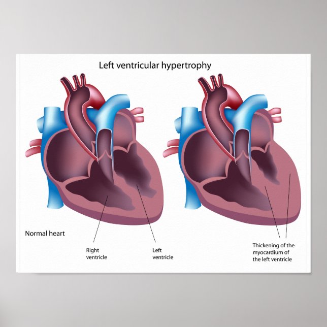 Póster Poster de hipertrofia cardiaca (Frente)