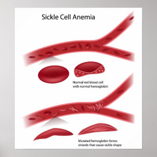Póster Poster de la anemia de células falciformes