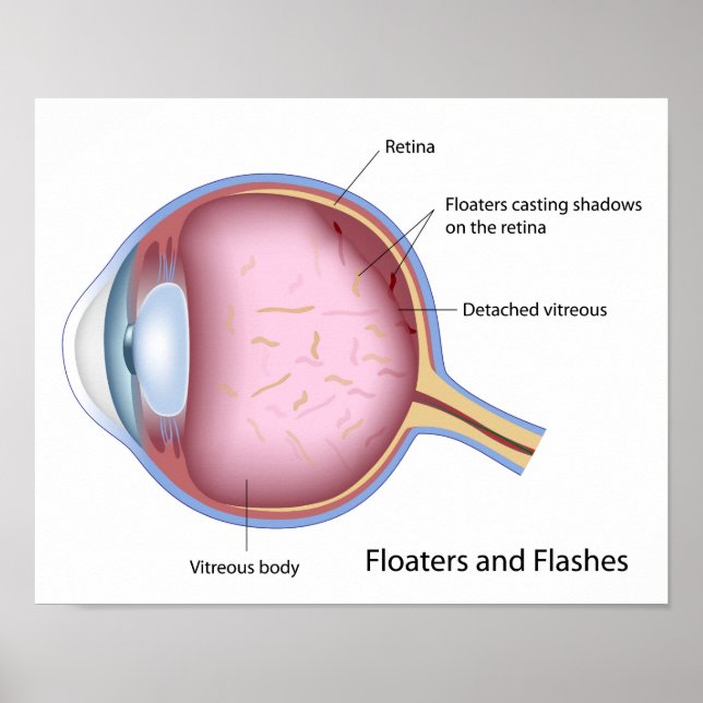 Póster Poster de la enfermedad ocular de Floaters y Flash (Frente)
