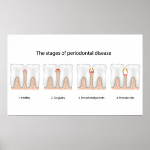 Póster Poster de la enfermedad periodontal del diente