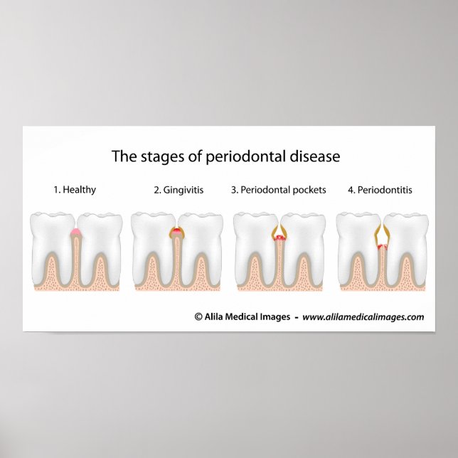 Póster Poster de la enfermedad periodontal dental (Frente)