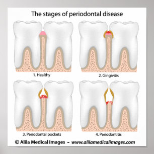 Póster Poster de la enfermedad periodontal dental