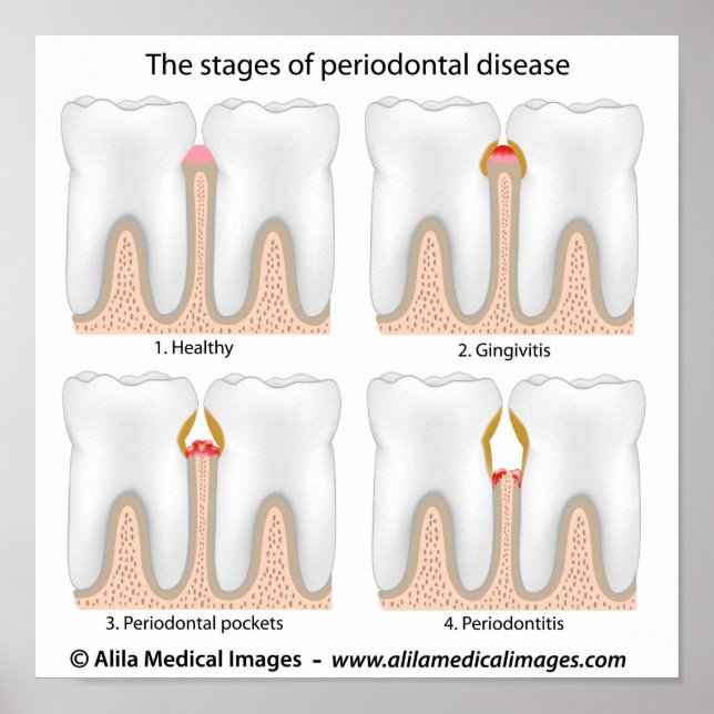 Póster Poster de la enfermedad periodontal dental (Frente)