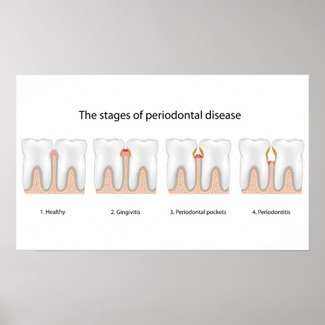 Póster Poster de la enfermedad periodontal dental (Frente)