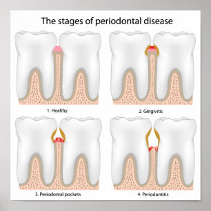 Póster Poster de la enfermedad periodontal dental