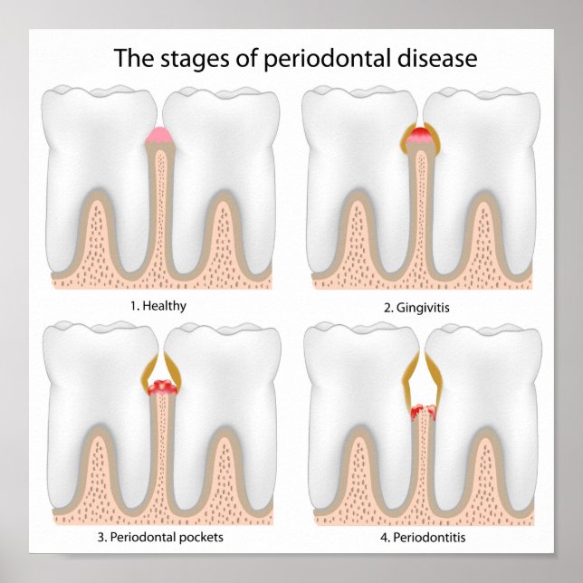 Póster Poster de la enfermedad periodontal dental (Frente)