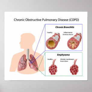 Póster Poster de la enfermedad pulmonar (EPOC)