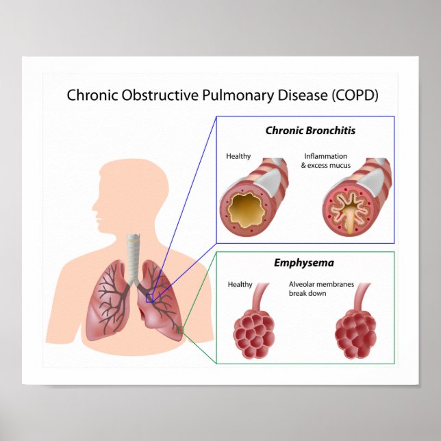 Póster Poster de la enfermedad pulmonar (EPOC) (Frente)