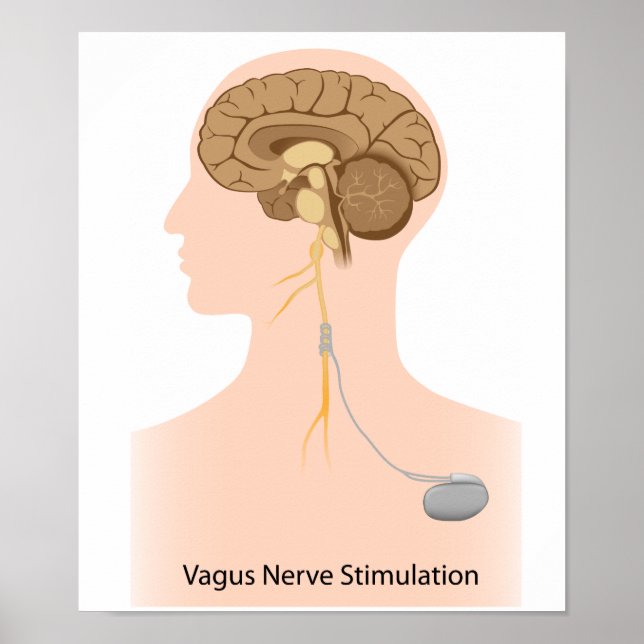 Póster Poster de la terapia de estimulación nerviosa de V (Frente)