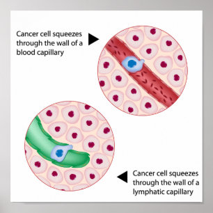 Póster Poster de metástasis en células de cáncer
