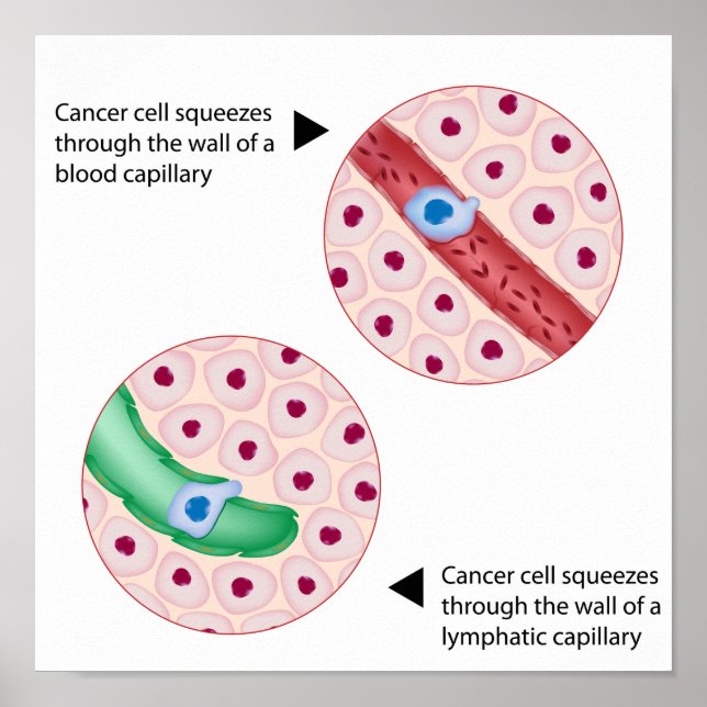 Póster Poster de metástasis en células de cáncer (Frente)
