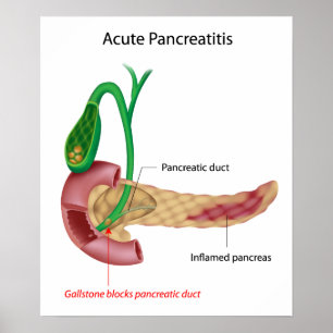 Póster Poster de pancreatitis aguda