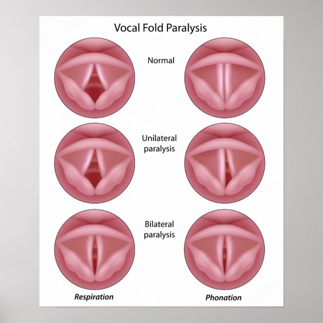 Póster Poster de parálisis del cordón vocal (Frente)