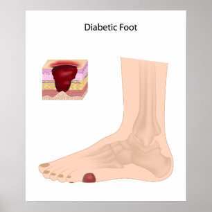 Póster Poster de pie diabético
