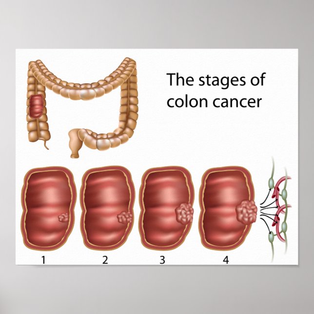 Póster Poster de progresión del cáncer de colon (Frente)